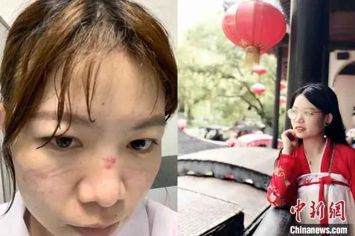 资料图:在湖北“抗疫”一线奋战的护士李万荣脸上被压出伤痕。吴兰 摄 天使,节日快乐!